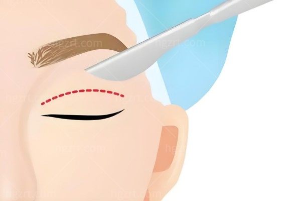 佀同帅和朱迪双眼皮选哪个？双眼皮/眼修复医生选这俩都不踩雷