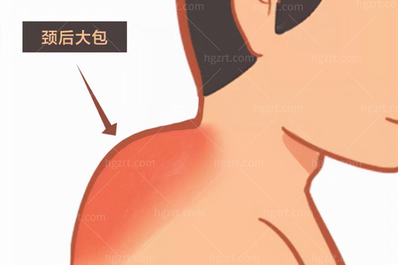 温州富贵包消除术哪家好做的好