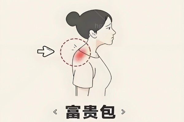 消除富贵包