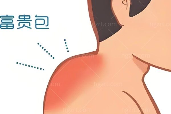 黄学峰消除富贵包多少钱