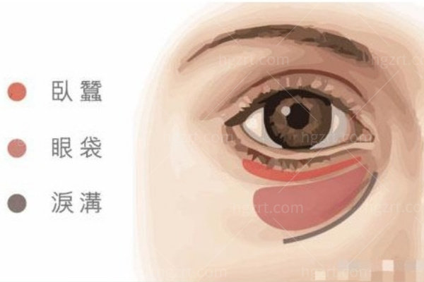 南宁健丽医美祛眼袋正规吗?正规,不开刀祛眼袋5440元起技术靠谱