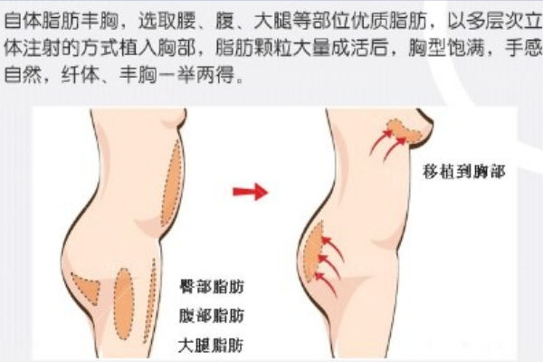 北京圣嘉新李春财脂肪隆胸怎么样?价格约2w起手术实例多患者口碑赞