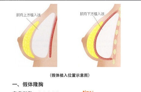 26年版穆大力隆胸收费标准已更新：不同品牌假体价格一览