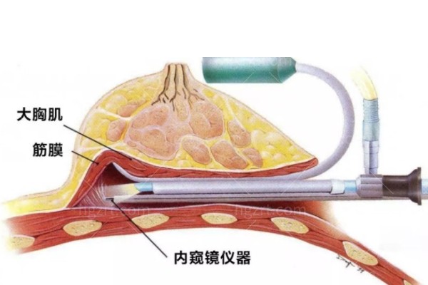 穆大力隆胸收费标准