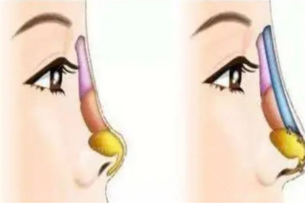 朱刚强鼻子做得怎么样