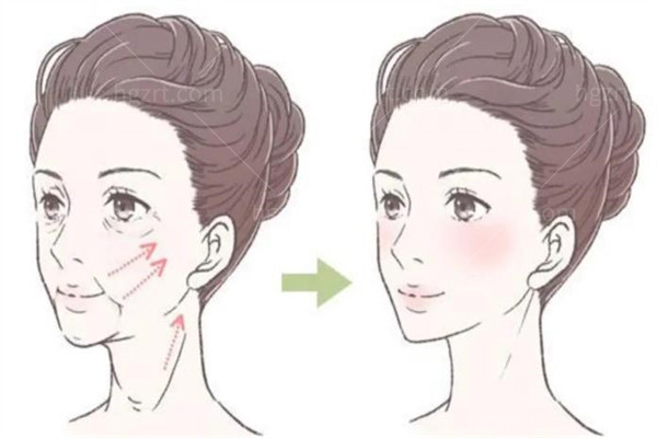 广州黄广香拉皮价目表‌一览，小切口4万起大拉皮5万起