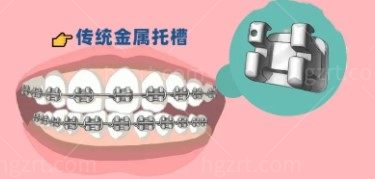 矫正牙收费价目表