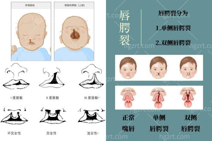 唇腭裂可以申请补助吗