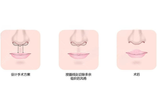 人中缩短手术正规吗