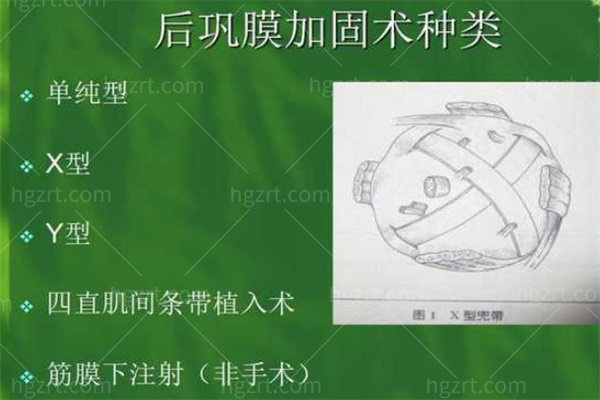 王乐今后巩膜加固术费用明细一览:价格3.6万起主做微创/附详细坐诊医院及时间表