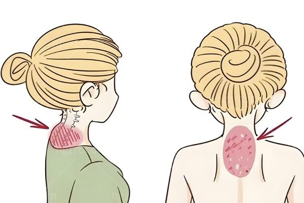  富贵包/背部吸脂