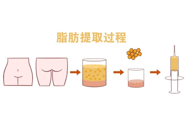 郑州脂肪填充正规整形医院