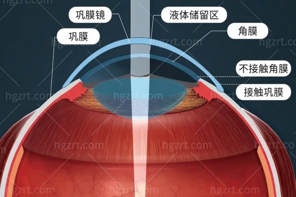 巩膜镜一年后全部瞎了是真的吗？扒一扒巩膜镜为什么不建议戴的真相！