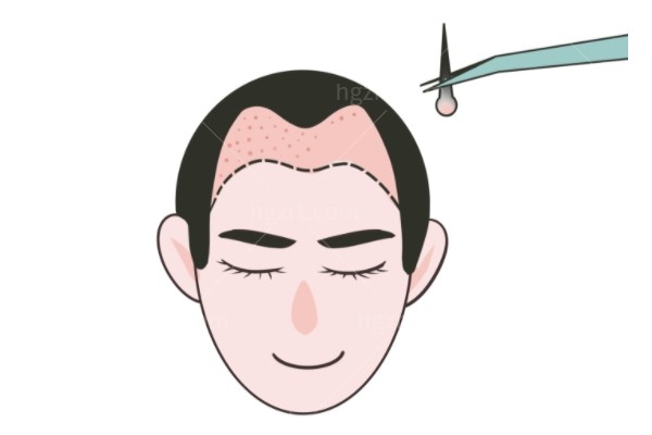 青穗植发是正规医院吗