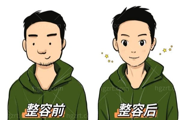 韩国GNG男士3D打印鼻整形十月好价！600万韩币开启自然鼻型蜕变
