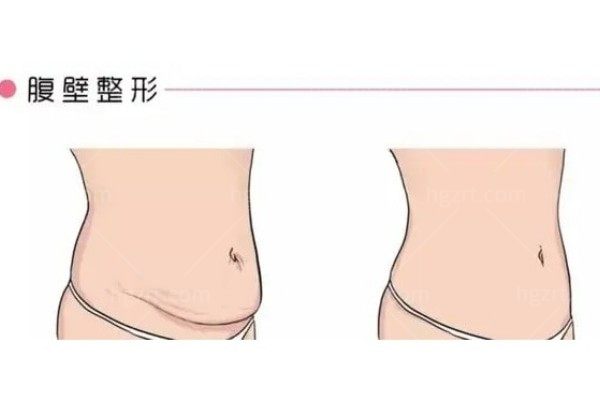 生完孩子肚子还是很大，想问下产后可以做腹壁成形术吗