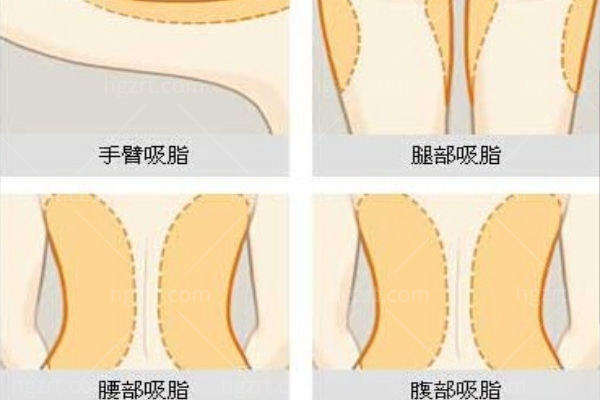 新版深圳吸脂整形医院价格表:腰腹1w+大腿8k+全身2w+可做填充丰盈面部/丰胸等