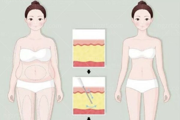 新版深圳吸脂整形医院价格表:腰腹1w+大腿8k+全身2w+可做填充丰盈面部/丰胸等