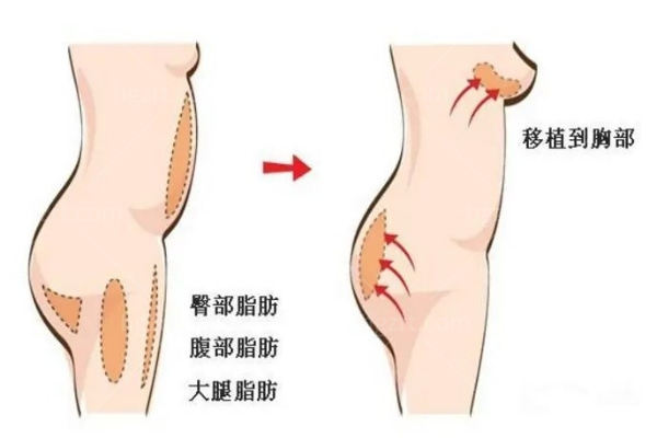 新版深圳吸脂整形医院价格表:腰腹1w+大腿8k+全身2w+可做填充丰盈面部/丰胸等
