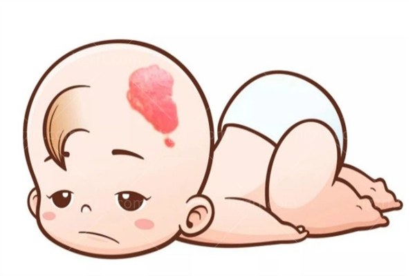 鲜红斑痣激光治疗为啥做了40次还没好？这几点很多人都没搞懂！