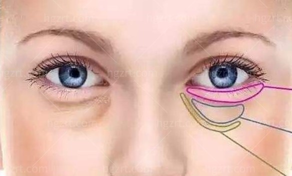 健丽医美做眼袋可靠吗？