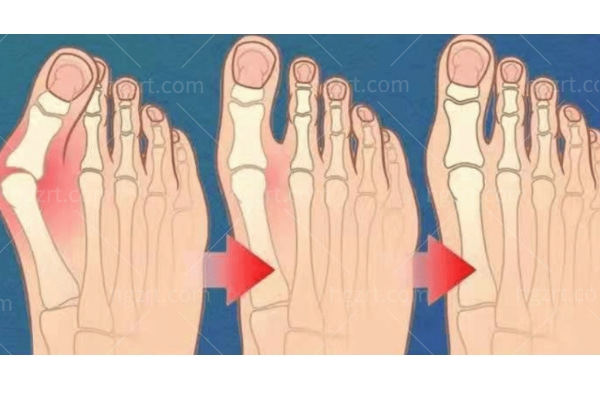 苏敬达拇外翻手术到底怎么样