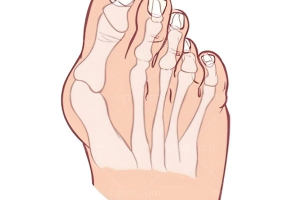 苏敬达拇外翻手术多少钱