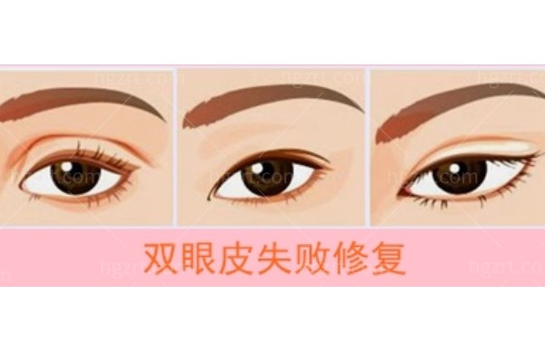 侯文明医生修复双眼皮怎么样