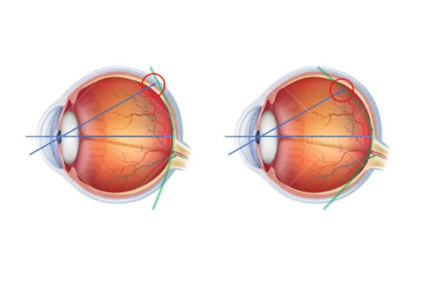 奥拉怒放近视管理镜片怎么样?2025年深度解析:从技术原理到使用成效的全方位指南