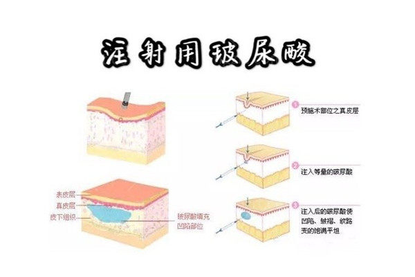欣菲聆玻尿酸和伊婉玻尿酸哪种好? 欣菲聆玻尿酸和伊婉玻尿酸哪种好?