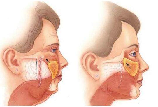 北京李晓东医生是在黄寺医院坐诊,PSV 高位提升专攻中重度松弛,20年经验+数千例病例 北京李晓东医生是在黄寺医院坐诊,PSV 高位提升专攻中重度松弛,20年经验+数千例病例