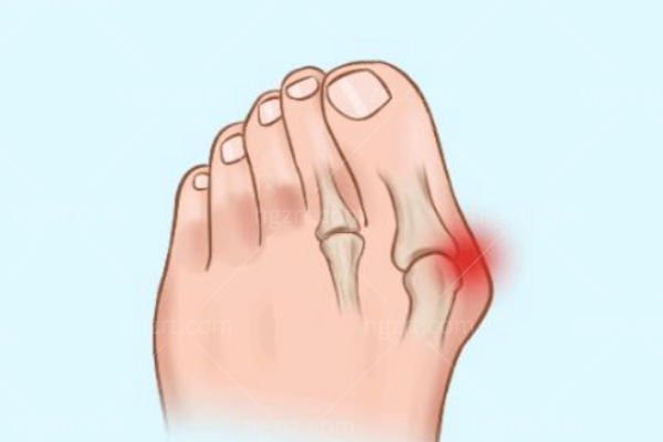 苏敬达拇外翻和传统矫正哪个好 苏敬达拇外翻和传统矫正哪个好