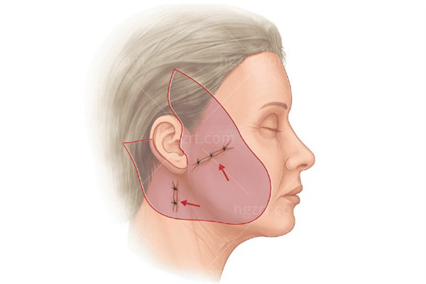 ​北京三大拉皮手术医院排名榜出炉!黄寺/加减美/奥尔贝德技术代表医生名单分享