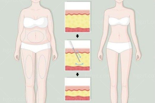 大腿内则没有多余脂肪可以在肚子上取脂肪做填充手术吗？