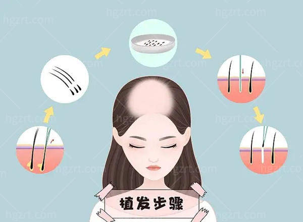 公开雍禾植发医院收费价格表 发际线/不剃发/私密种植价格都不相同