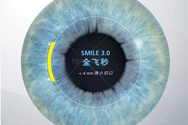 广州阿玛施眼科价格表大公开 在广州阿玛施做近视眼8000起白内障6300起