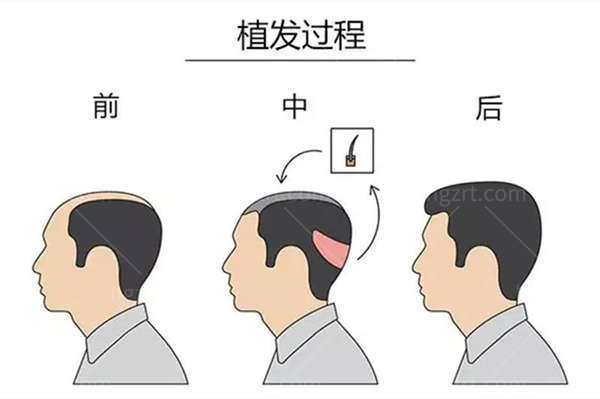 广州曙光植发发际线种植项目价格详解