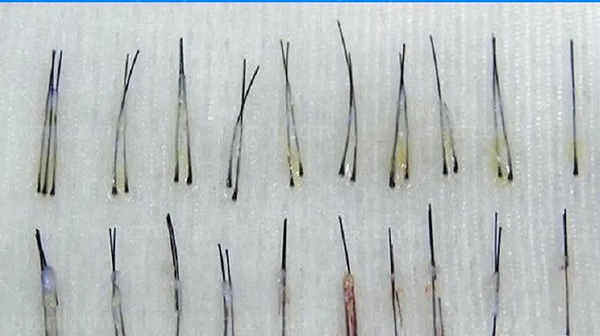 广州曙光植发理性选择植发方案