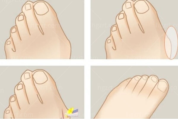 大脚骨一定要做手术吗？一文详解拇外翻手术的所有真相