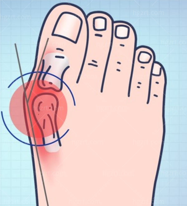 什么情况下大脚骨需要手术