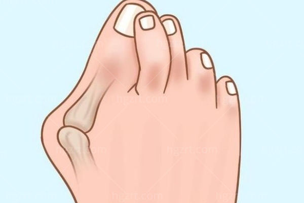 如何预防大脚骨的发生和发展