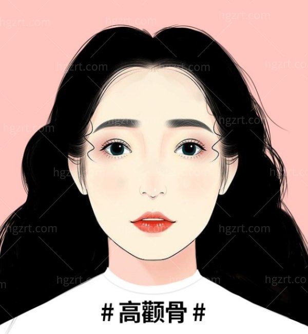 颧骨内推手术好不好