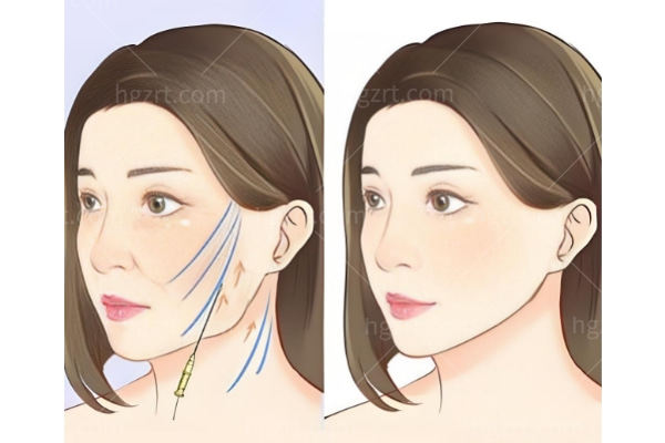 王易彬面部微整提升成效怎么样?技术/价格/维持时间全解析