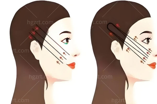 王易彬面部微整提升技术好吗