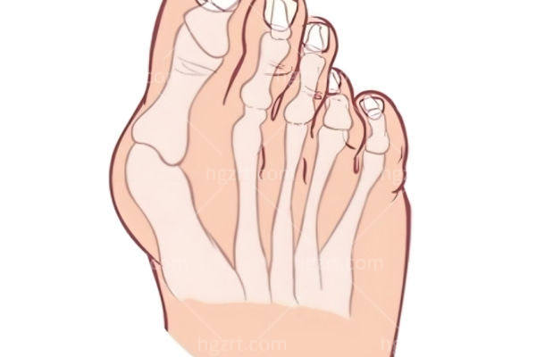 上海拇指外翻微创手术哪家强？推荐上海虹桥医院/宏康医院/丽质医疗美容技术都不差