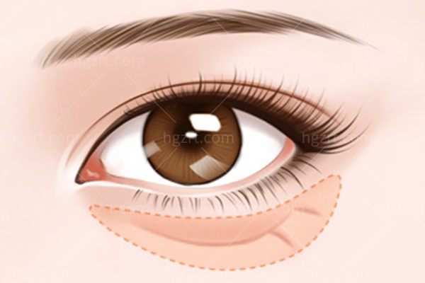 推荐福州祛眼袋好的整形医院：名韩/海峡/美贝尔/伽禾伽美都是实力派