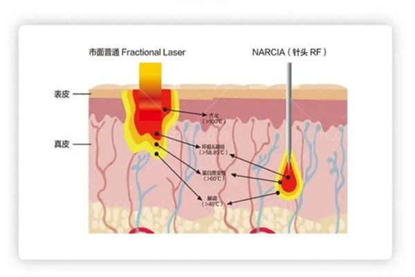 韩国清潭美乐皮肤科11月优惠活动价格表：丽珠兰/黄金微针费用都不贵