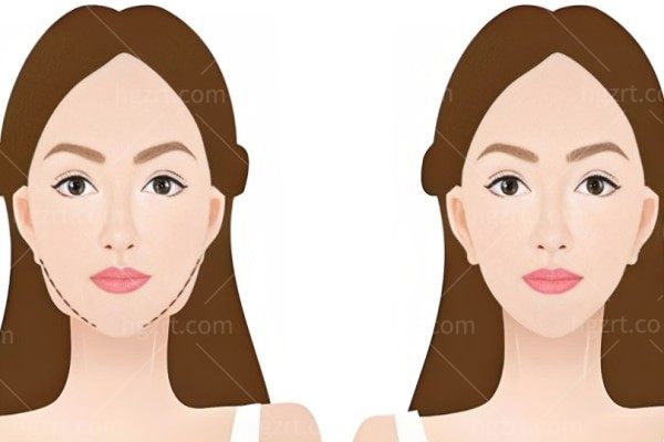 哪种医美方式可以使面部更加饱满？