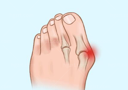  上海虹桥医院做拇指外翻超微创手术多少钱