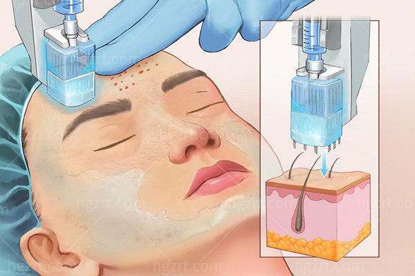 50岁以上打什么水光